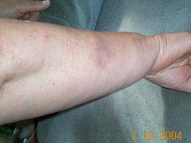 Debs bruised arm.jpg